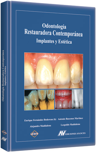 Odontología Restauradora Contemporánea Implantes y Estética