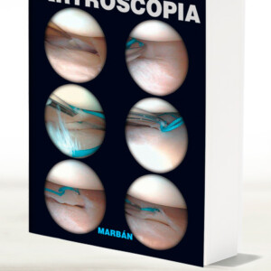 Artroscopia
