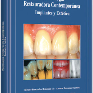 Odontología Restauradora Contemporánea Implantes y Estética